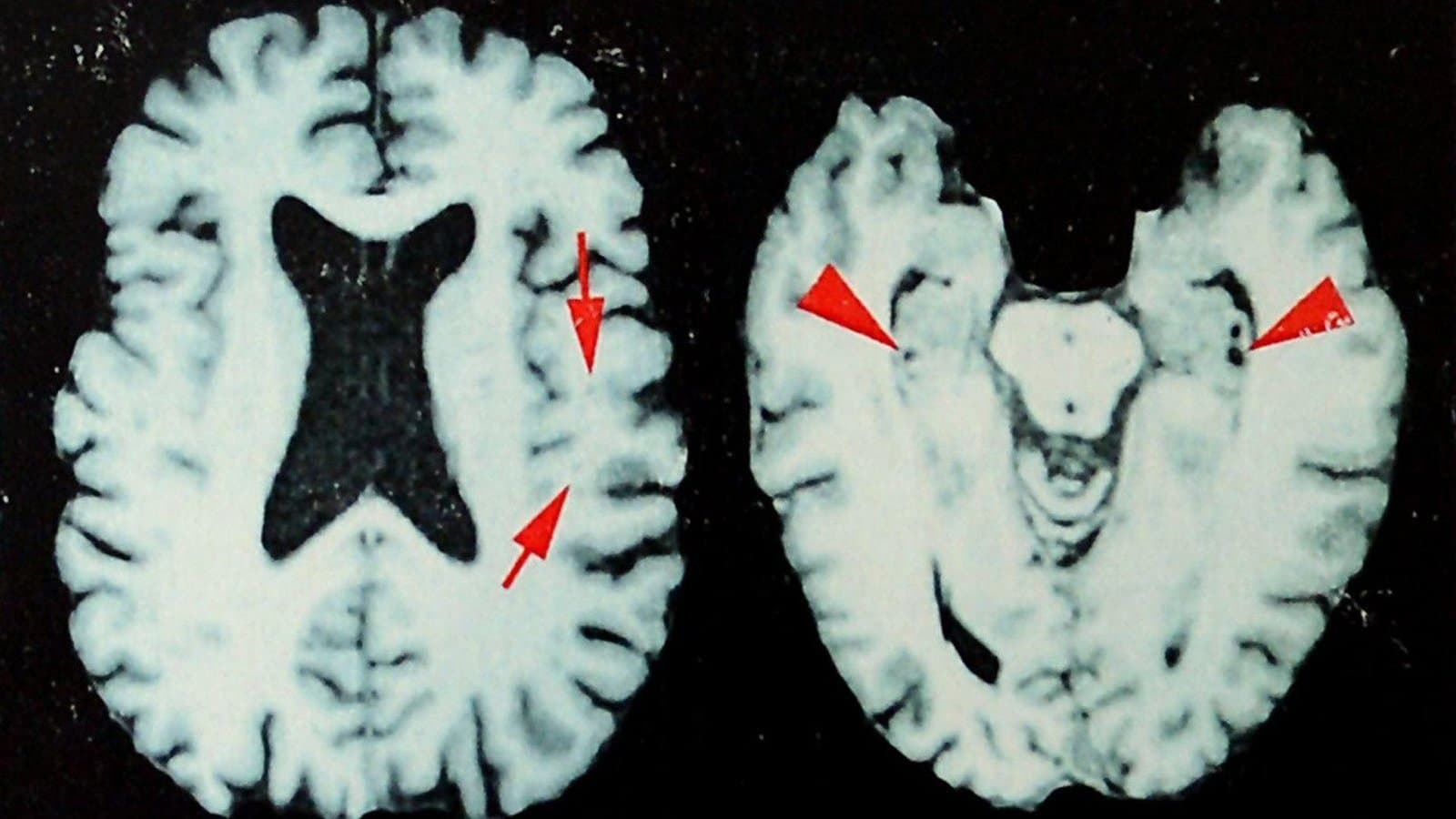 CTE Prevalence Among Deceased NFL Players Revealed